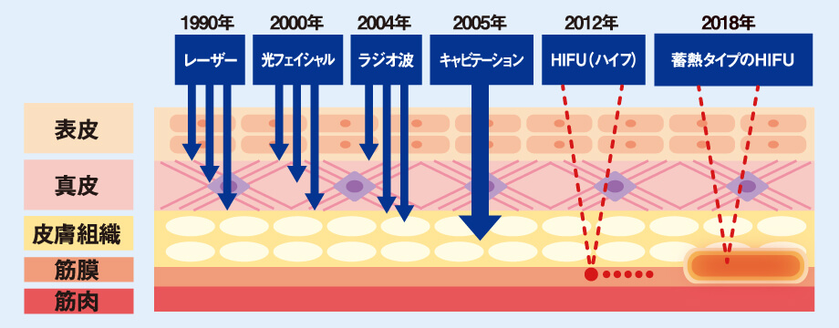 2012年 HIFU → 2018年 蓄熱タイプのHIFU